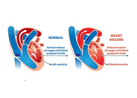 lvsd heart condition.